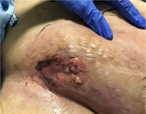 Figure 1 Cellulitis radiating outward from a ruptured bulla overlying a recent vascular access site