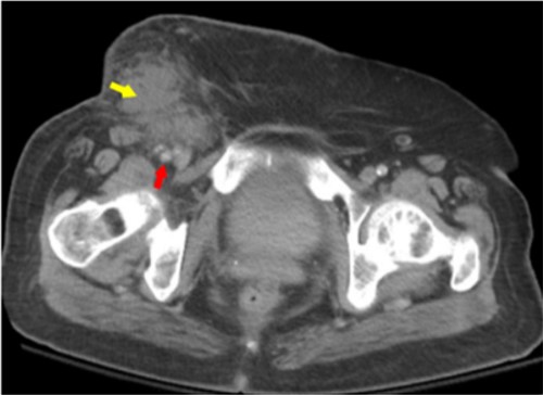 Figure 2 Axial view of abdomenslashpelvis CT scan with contrast showed area of subcutaneous infiltration consistent with cellulitis with phlegmon yellow arrow near the femoral artery red arrow