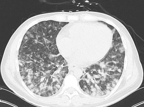 Figure 2 CT of the chest showing severe diffuse ground-glass opacities in the lower lung fields