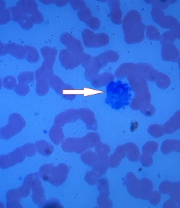 Figure 3 Peripheral smear demonstrating a monocyte with intracellular yeast spores arrow