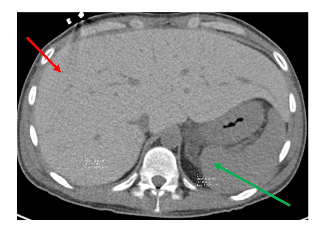 Figure CT of the abdomen without contrast demonstrating hyperdensity of the liver red arrow 84 Hounsfield units relative to the spleen green arrow 44 Hounsfield units normal range 50 to 75 Ho