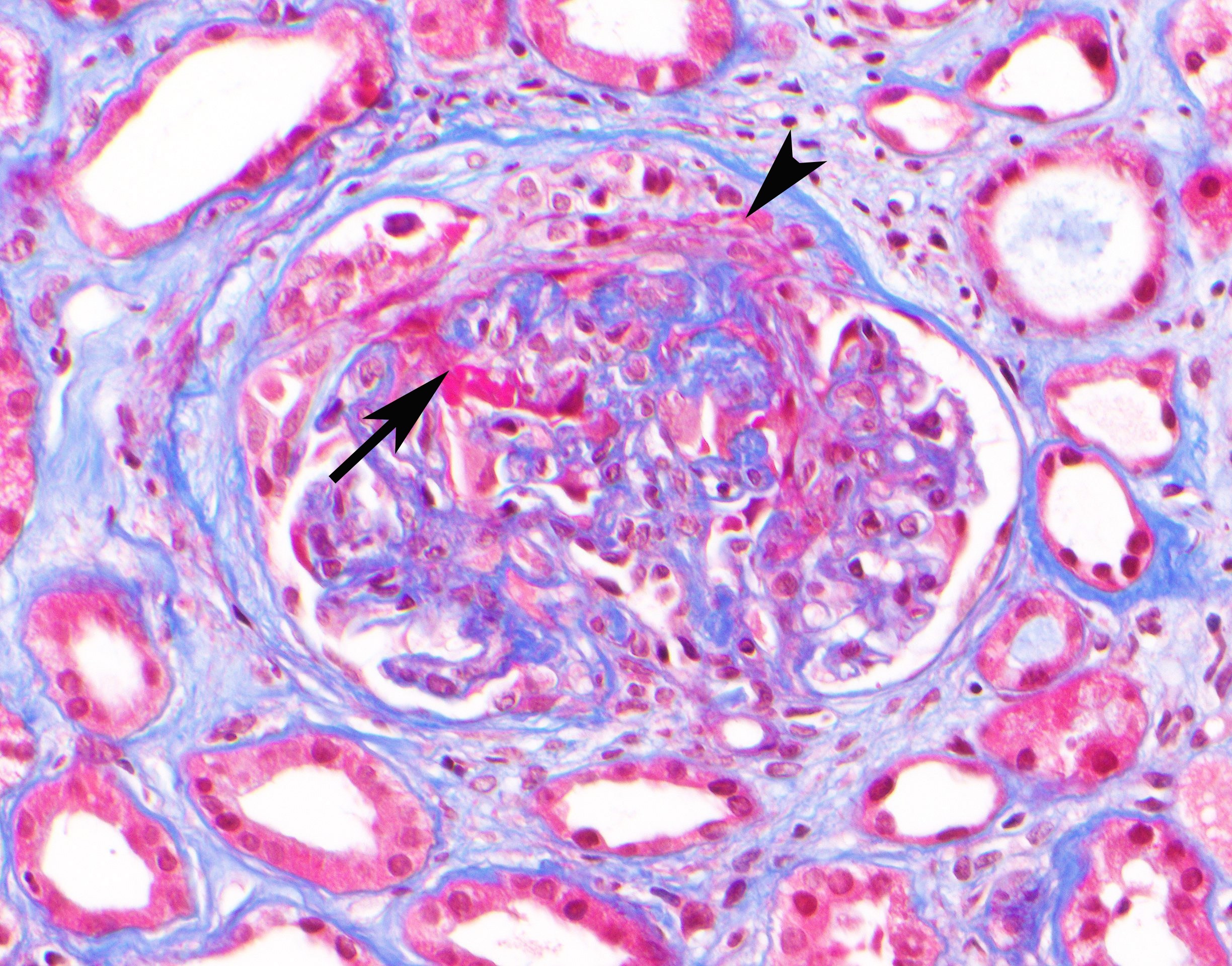Figure Kidney biopsy demonstrating glomerulus with a cellular crescent arrowhead and necrosis arrow of the glomerular tuft Masson trichrome 400times magnification Immunofluorescence stainin