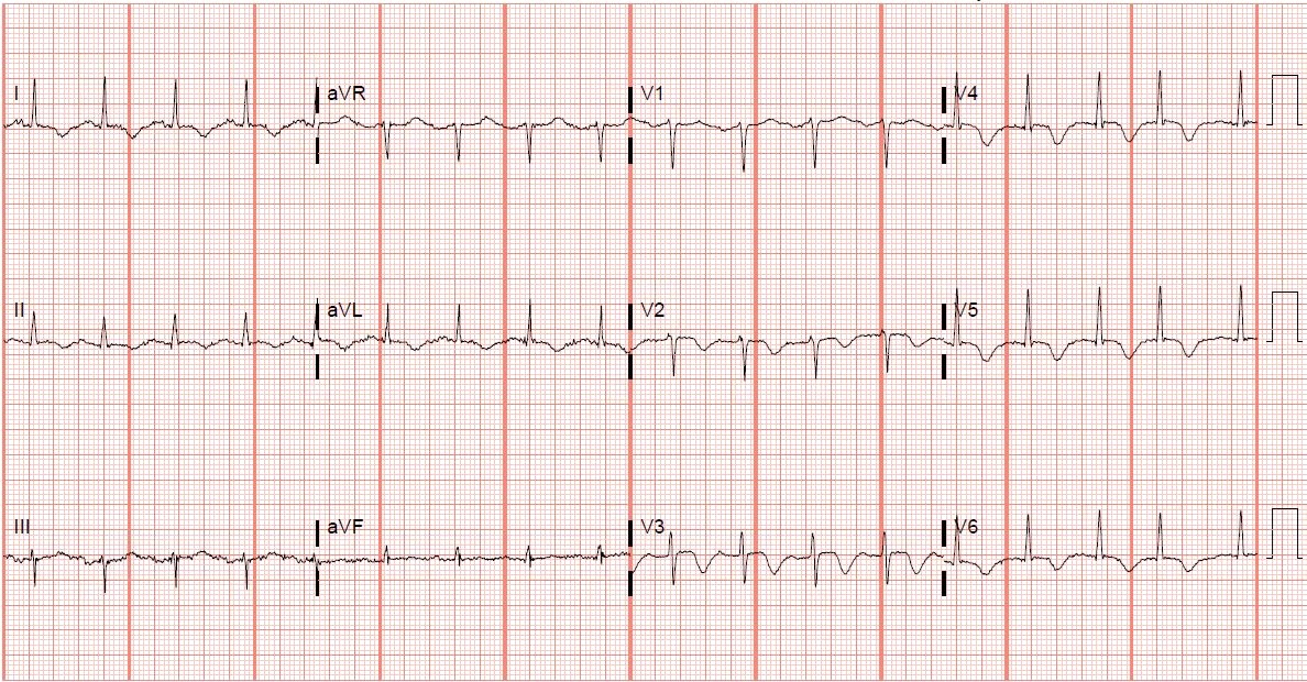 Figure 1 Initial 12-lead electrocardiogram demonstrating T-wave inversions extending across the precordial leads lead II and high-lateral limb leads
