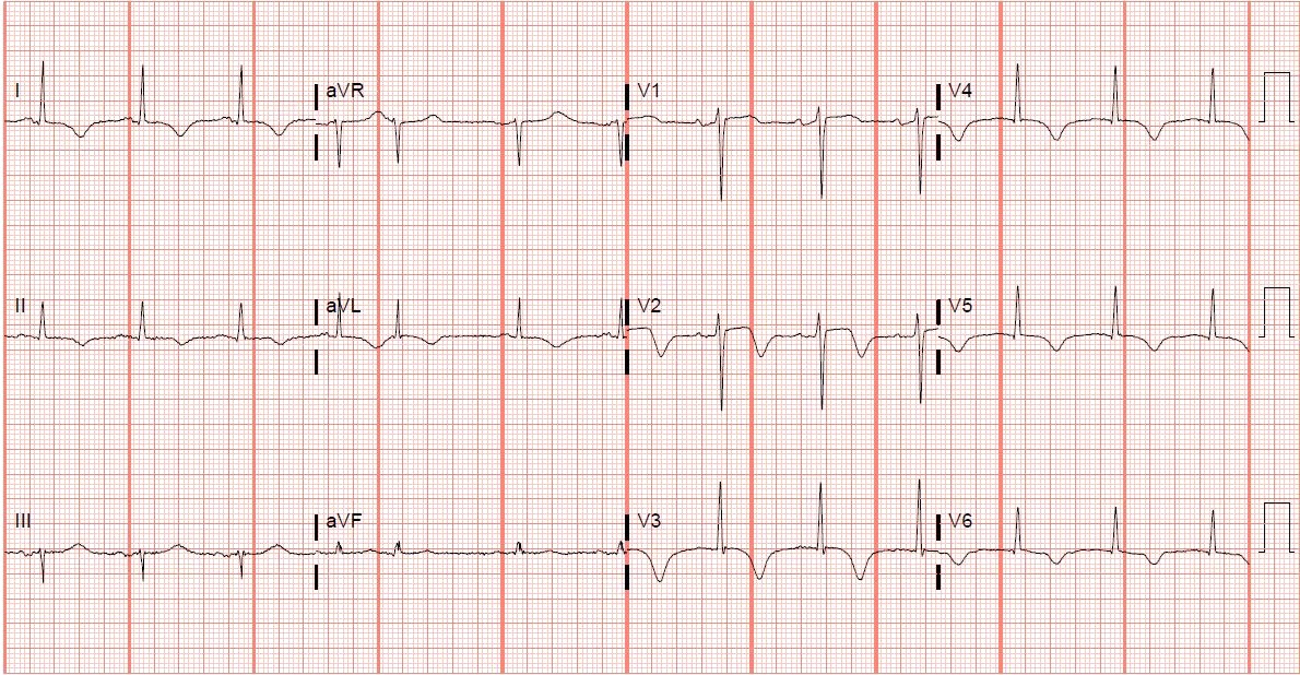 Figure 2 Repeat 12-lead electrocardiogram demonstrating dynamic changes in lead V2 appearing to be more biphasic