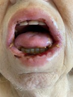 Figure 1 Oral mucositis as noted on admission Erythema edema and ulcerations of the oral mucosa can be seen along with cheilitis