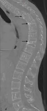 Figure 4 CT scan of the thoracic spine notable for compression fractures of T5 T7 and T10 vertebral bodies arrows
