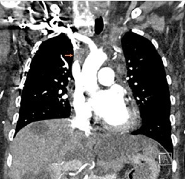 Figure 1 Chest CT angiography demonstrating SVC occlusion arrow