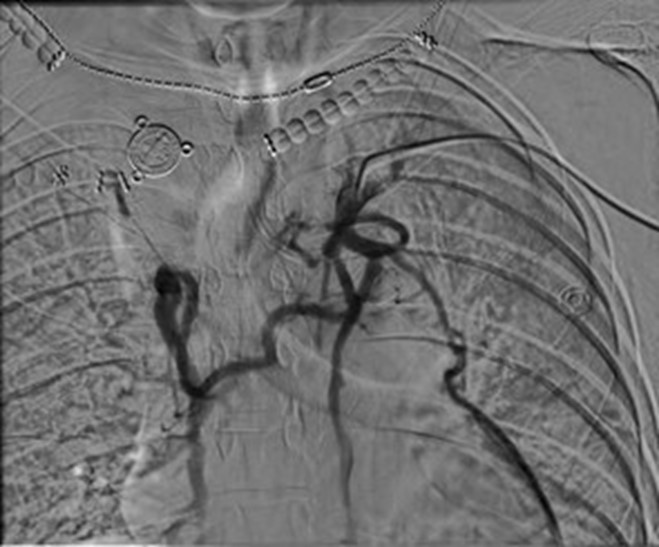 Figure 2 Angiography showing a large mediastinal collateral vein bypassing the left subclavian vein and SVC occlusions