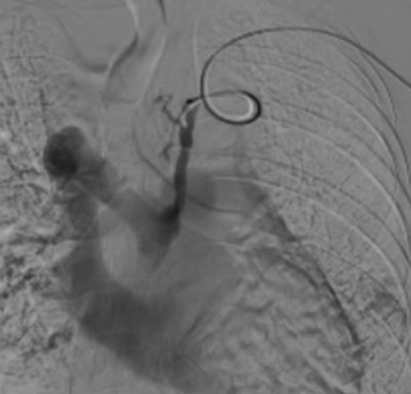 Figure 3 Angiography showing the mediastinal collateral vein draining into the SVC and right atrium