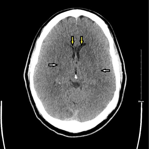 Figure CT of the head revealing diffuse cerebral edema with loss of grey-white differentiation white arrows and compression of ventricles yellow arrows