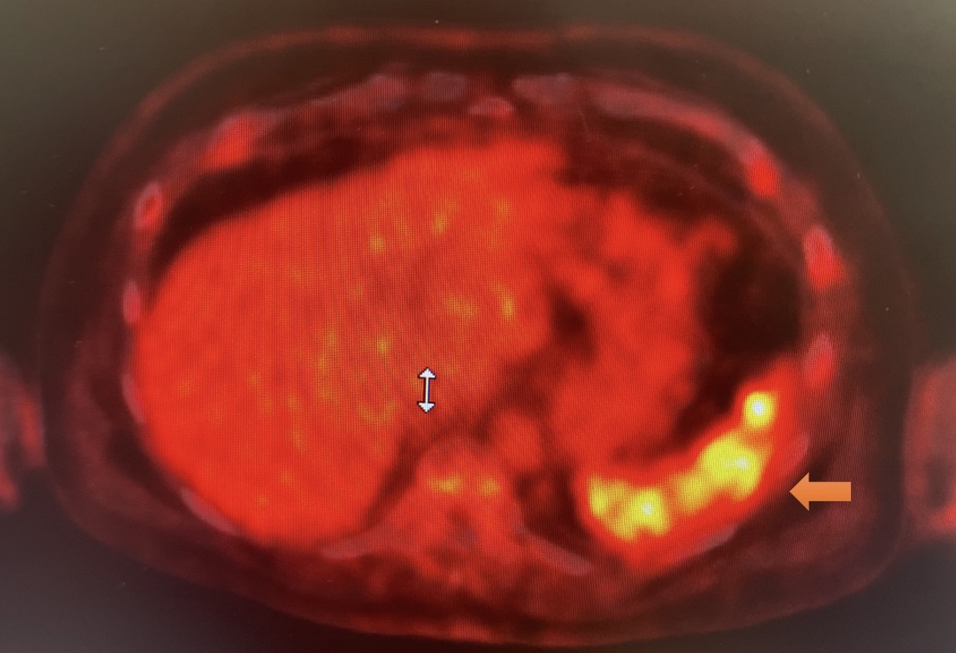 Figure 2 PET scan showing areas of increased uptake arrow indicative of lytic activity