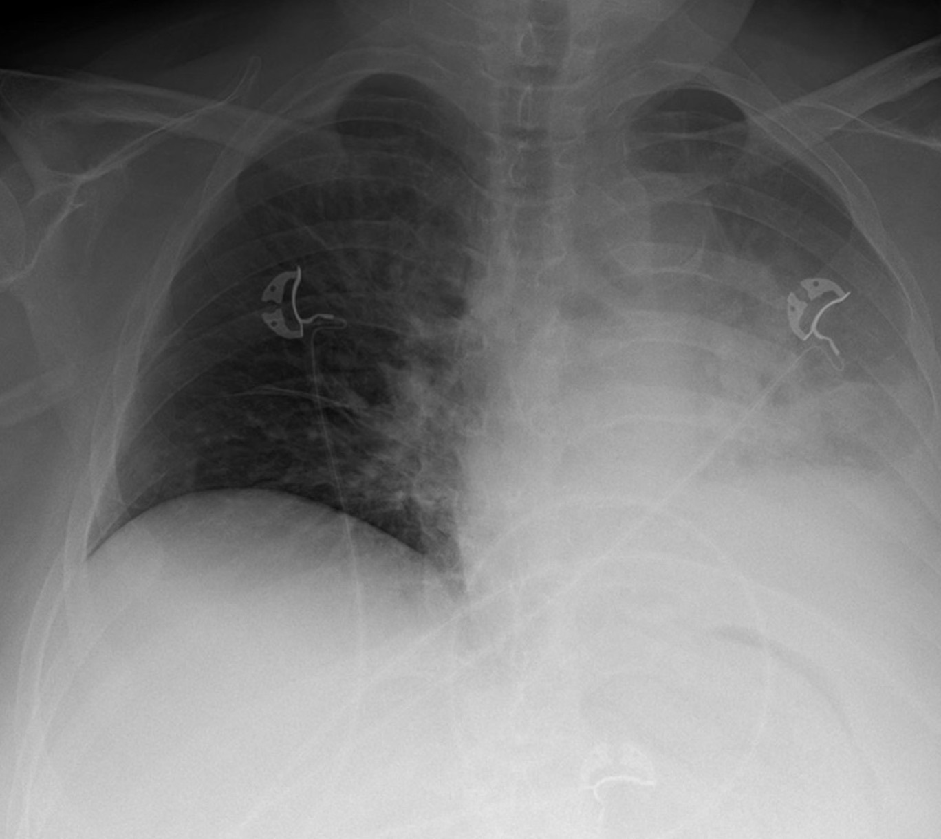 Figure 3 Chest X-ray showing large pleural effusion