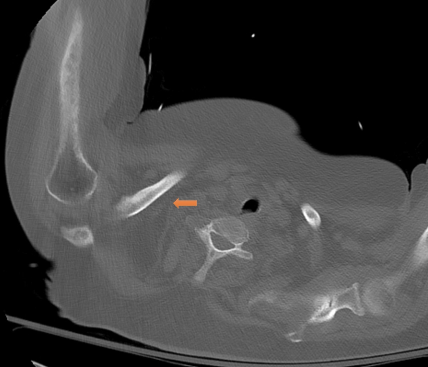 Figure 4 CT scan showing lytic lesions in clavicular head arrow