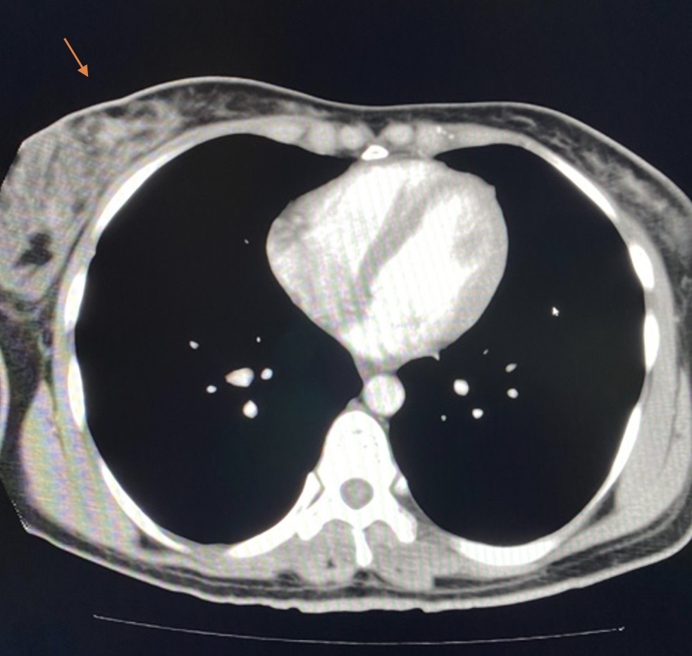 Figure 5 CT scan showing lytic lesions and breast mass arrow