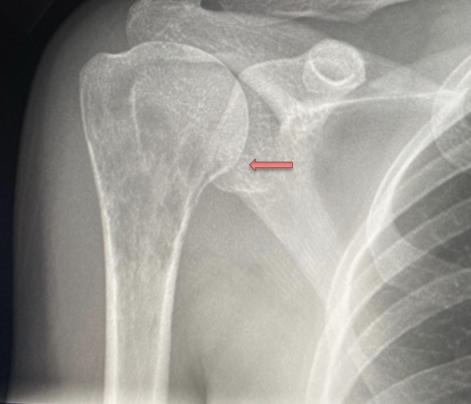 Figure 6 X-ray showing lytic lesion on proximal humerus arrow
