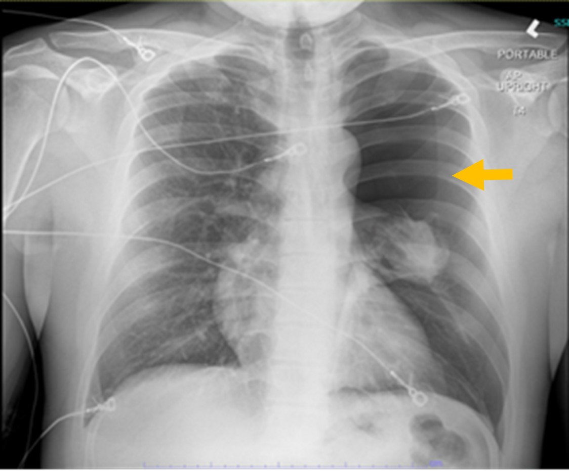 Figure 1 Chest X-ray on day of admission demonstrating large left-sided pneumothorax arrow