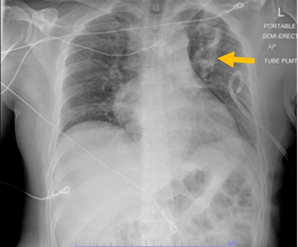Figure 2 Chest X-ray showing resolution of left-sided pneumothorax with residual left upper lobe atelectasis arrow after pigtail chest tube insertion