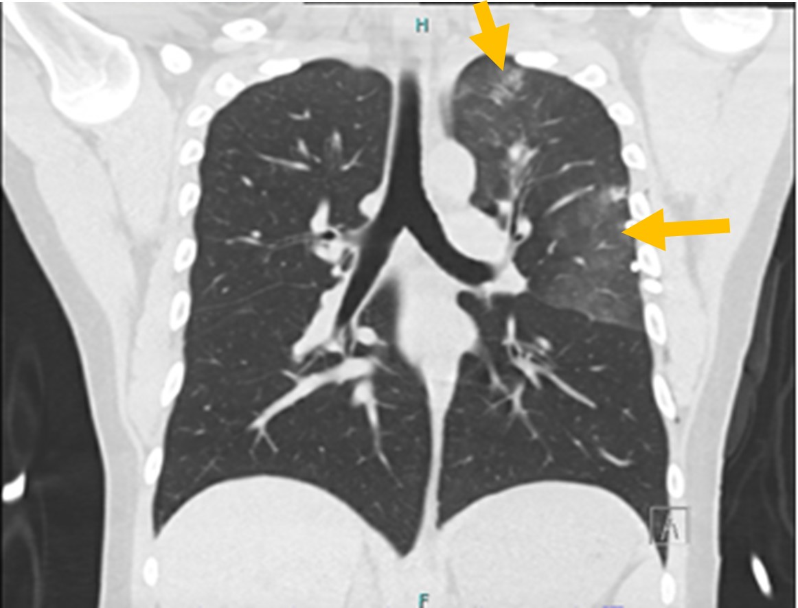 Figure 3 CT chest revealing new peripherally distributed multifocal ground-glass opacities in the left lung arrows without pulmonary cysts