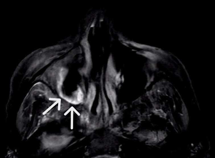 Figure 2 MRI T2 sequence shows right frontal sinus and periosteal enhancement white arrows