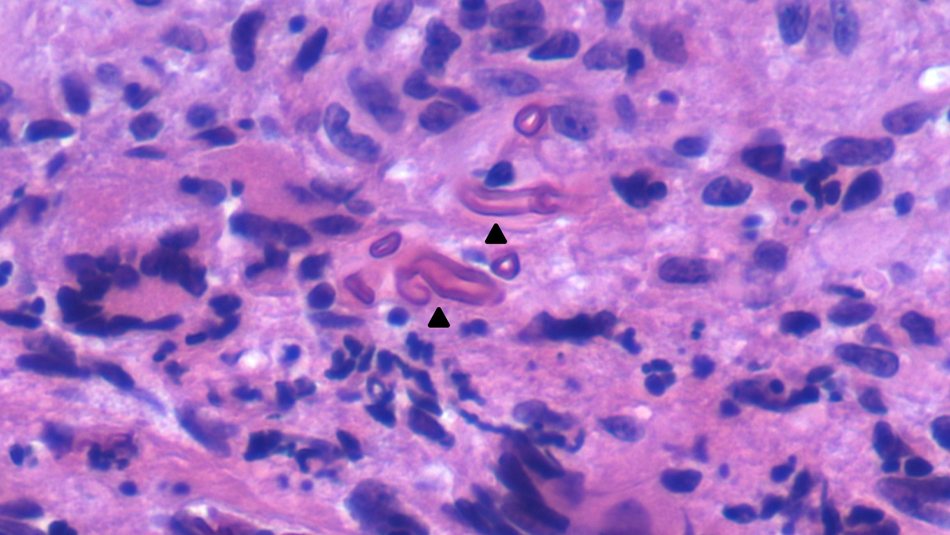 Figure 3 Histopathology of frontal sinus biopsy displays broad nonseptated ribbon-like hyphae black triangles