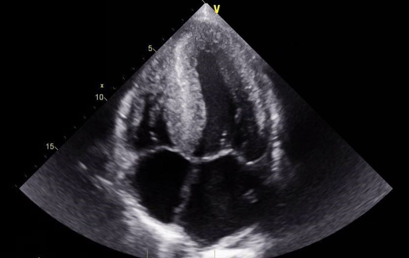 Figure 5 Apical four-chamber view displays severe myocardial thickening bi-atrial enlargement and speckling pattern in the intraventricular septum concerning for an infiltrative cardiomyopathy