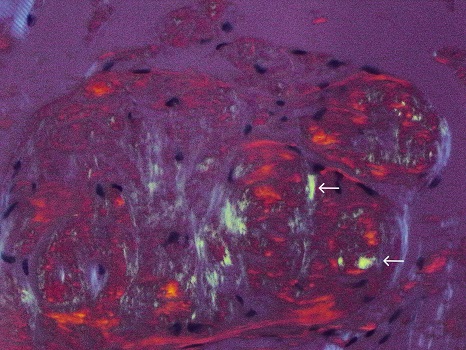 Figure 6 Congo red stain of tongue biopsy shows apple-green birefringence under polarized light white arrows