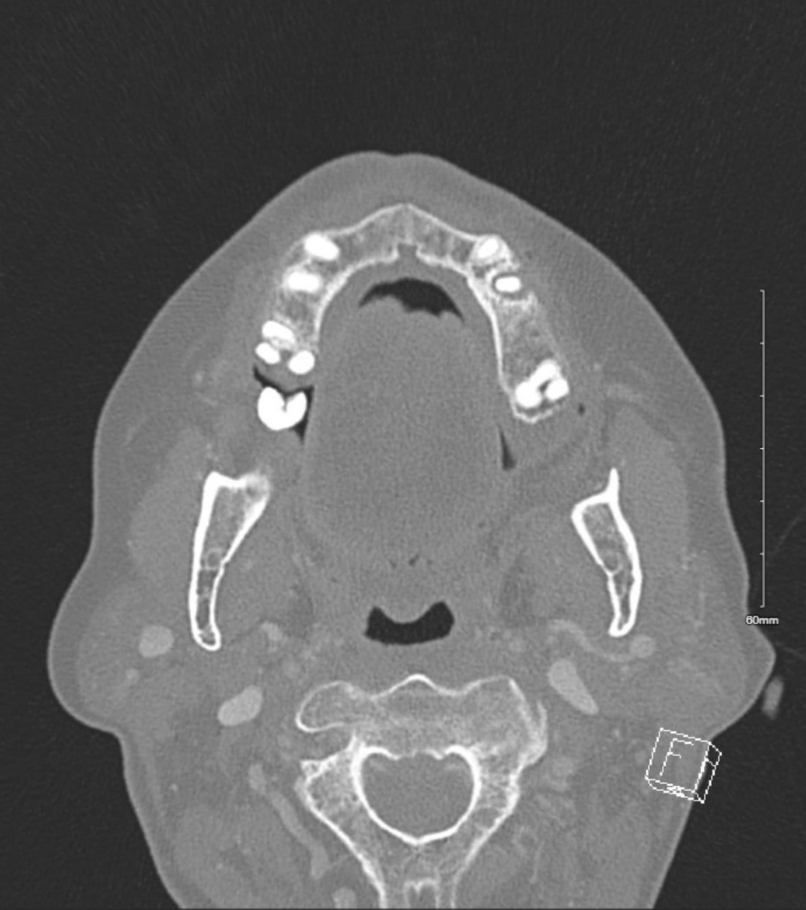 Figure 1 CT scan with lucencies in the posterior right mandibular tooth and second-to-the-front maxillary tooth consistent with dental disease