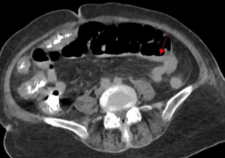 Figure 2 CT scan showing mild thickening of the colon red arrow