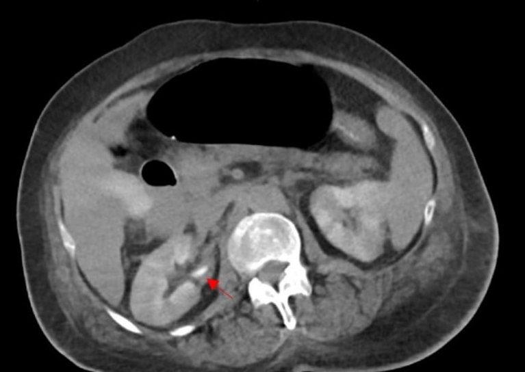 Figure 3 CT scan showing residual contrast in the kidneys red arrow