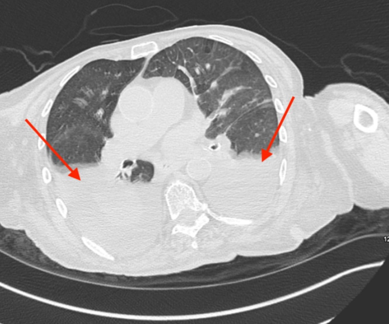 Figure 4 Noncontrast CT of the chest showing worsening third spacing with increased anasarca and increased size of large right layering pleural effusion red arrows