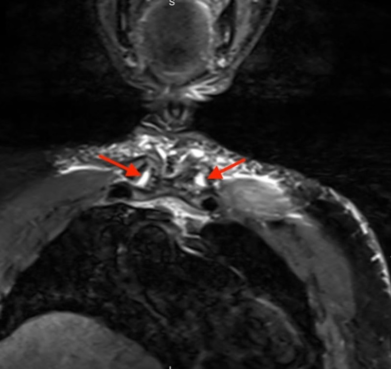 Figure 5 Chest MRI without contrast showing osteoarthritis of bilateral sternoclavicular joints red arrows