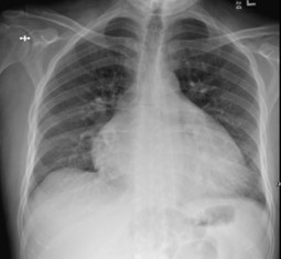 Figure 1 Chest X-ray on admission showing cardiomegaly