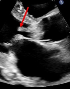 Figure 2 Transthoracic echocardiography showing large vegetation infiltrating the aortic valve arrow