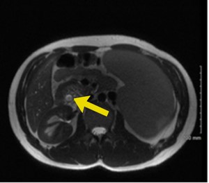 Figure 1 MRCP demonstrating common bile duct dilation to 09 cm yellow arrow