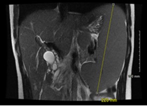 Figure 2 MRCP showing splenomegaly measuring 22 cm in craniocaudal dimension yellow line